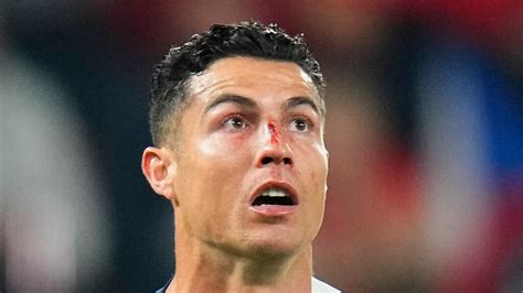 Ronaldo nase